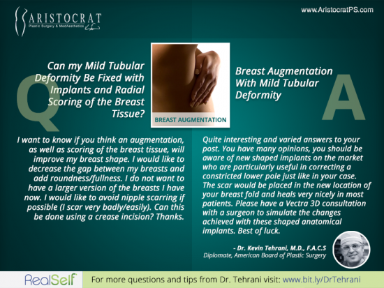 breast-augmentation-aristocratps