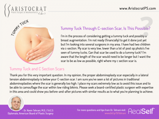 Tummy Tuck Procedure