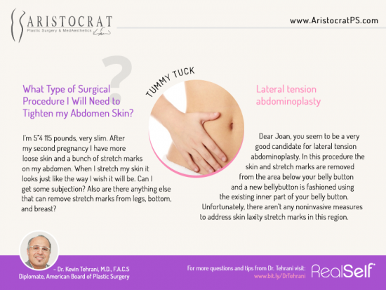 Lateral Tension Abdominoplasty - Aristocrat Plastic Surgery