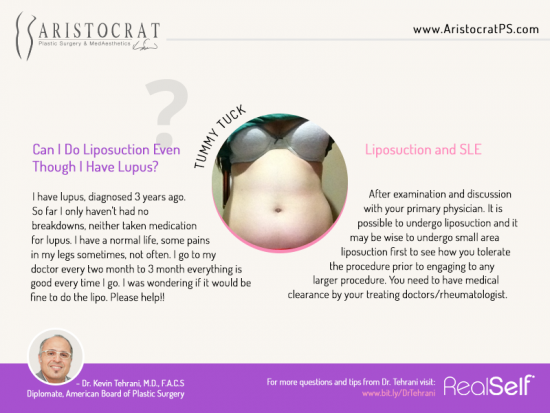 Liposuction with Lupus - Aristocrat Plastic Sugery