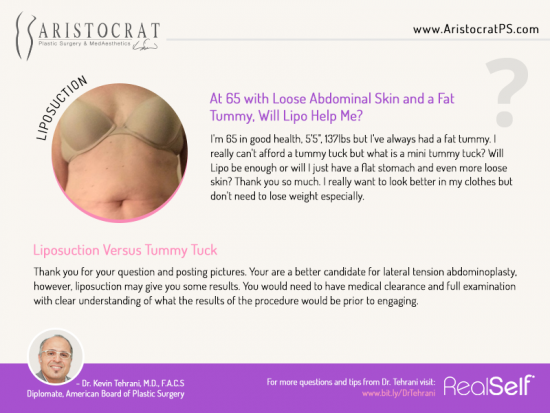 Liposuction vs Tummy Tuck - Aristocrat Plastic Surgery