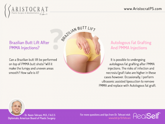 Brazilian Butt Lift After PMMA Injections? – Aristocrat Plastic Surgery