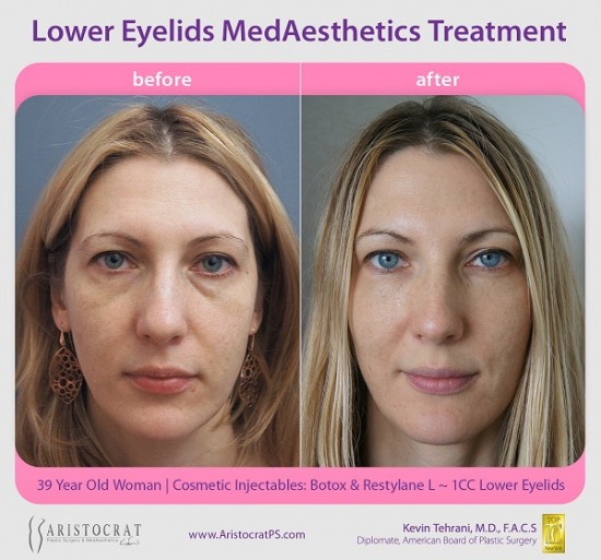 before-after-restylane-botox