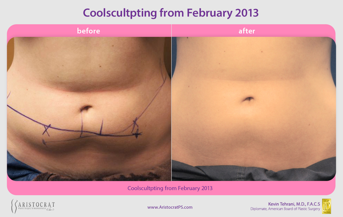 coolsculpting