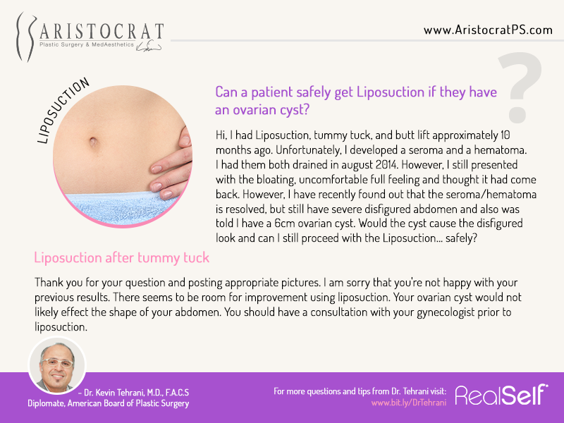 tummy tuck and liposuction