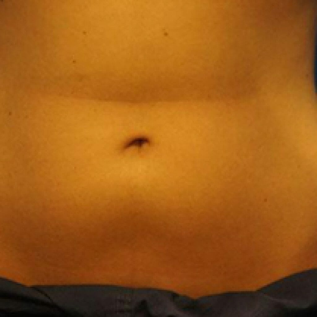 smallcoolsculpting