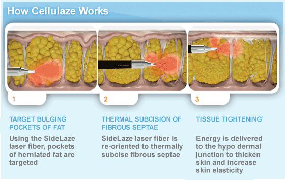 cellulaze