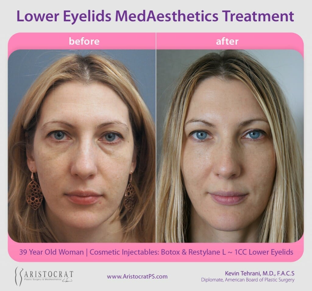 lower-eyelids-botox-before-after-1024x955