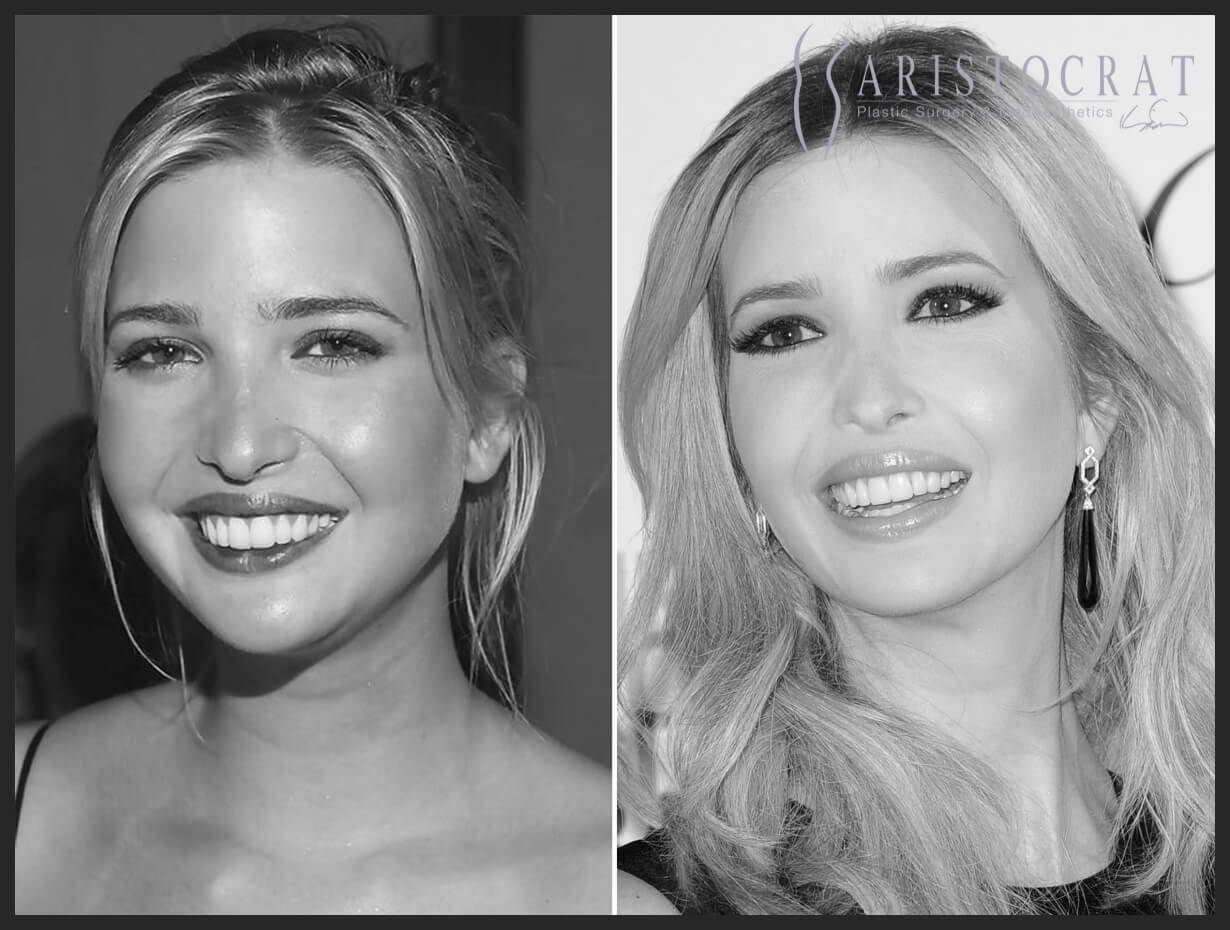 ivanka-trump-before-and-after (1)
