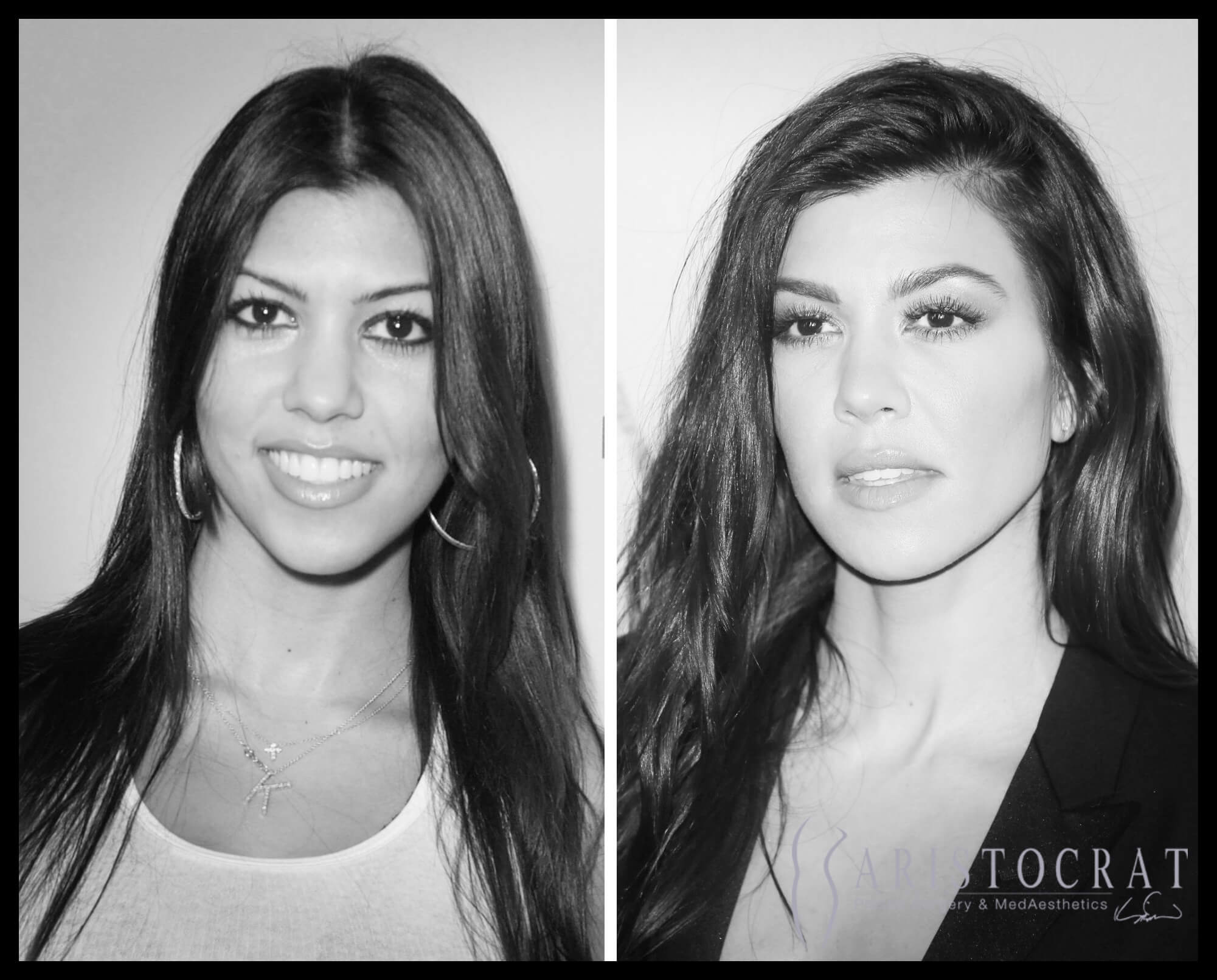 Kourtney Kardashian'S Plastic Surgery Rumors Debunked - vgg5itb