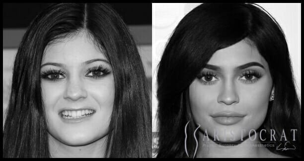 kylie-jenner-before-and-after-plastic-surgery-1