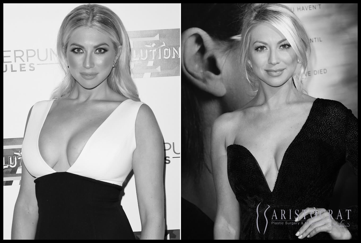 Stassi boob reduction
