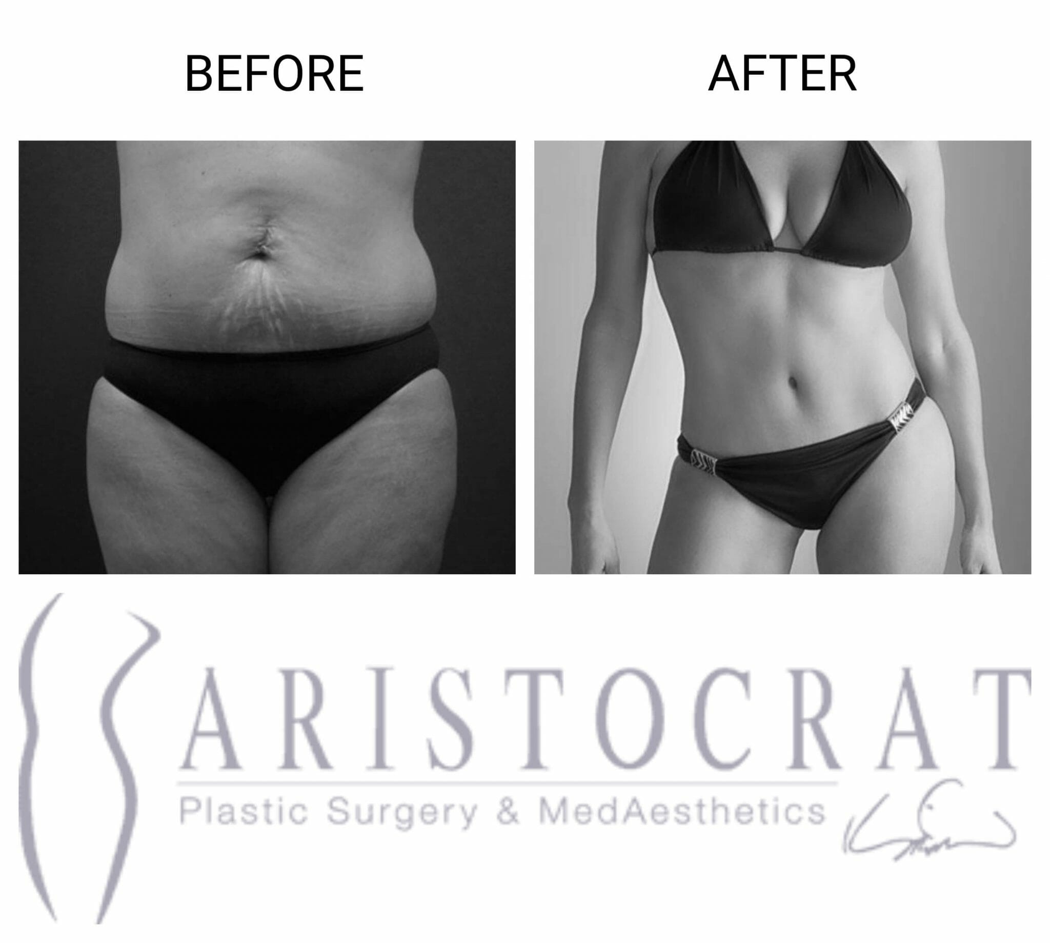 Lipo For Women Before & After NYC