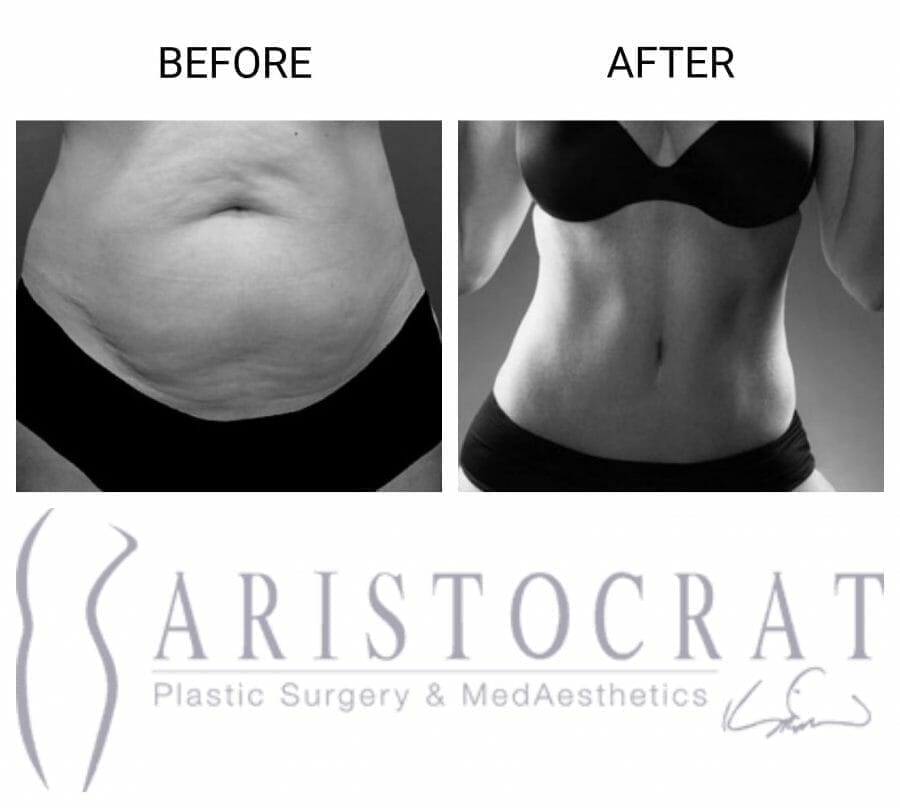 43 Times Liposuction Transformed Our Patients Before and After Pictures Aristocrat Plastic 