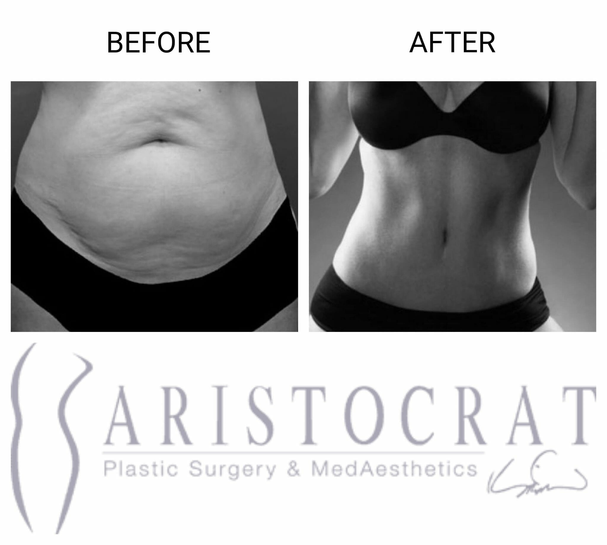 Eves Body Organic MedSpa - Before and After Bra line Lipo