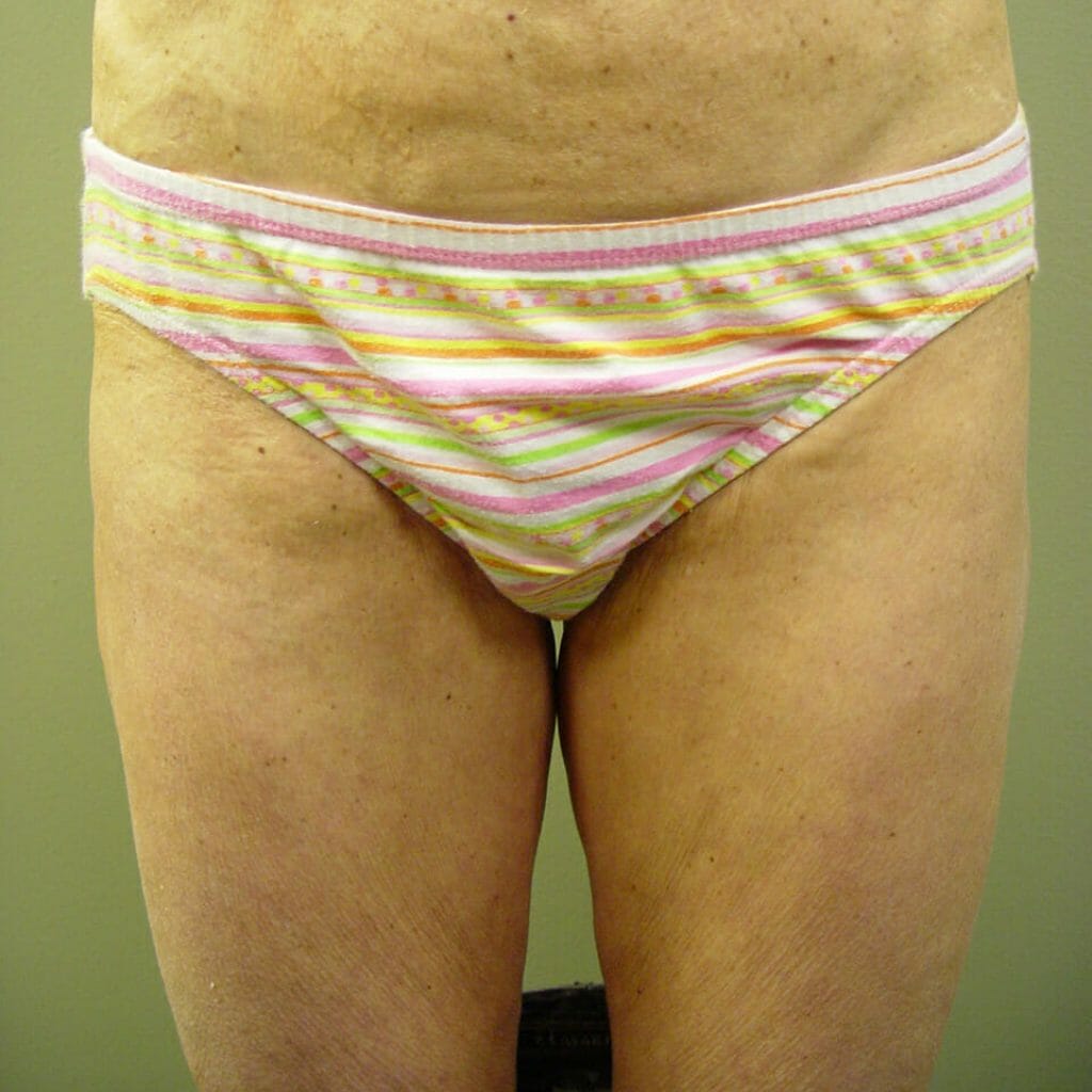 thigh lift aristocrat plastic surgery new york