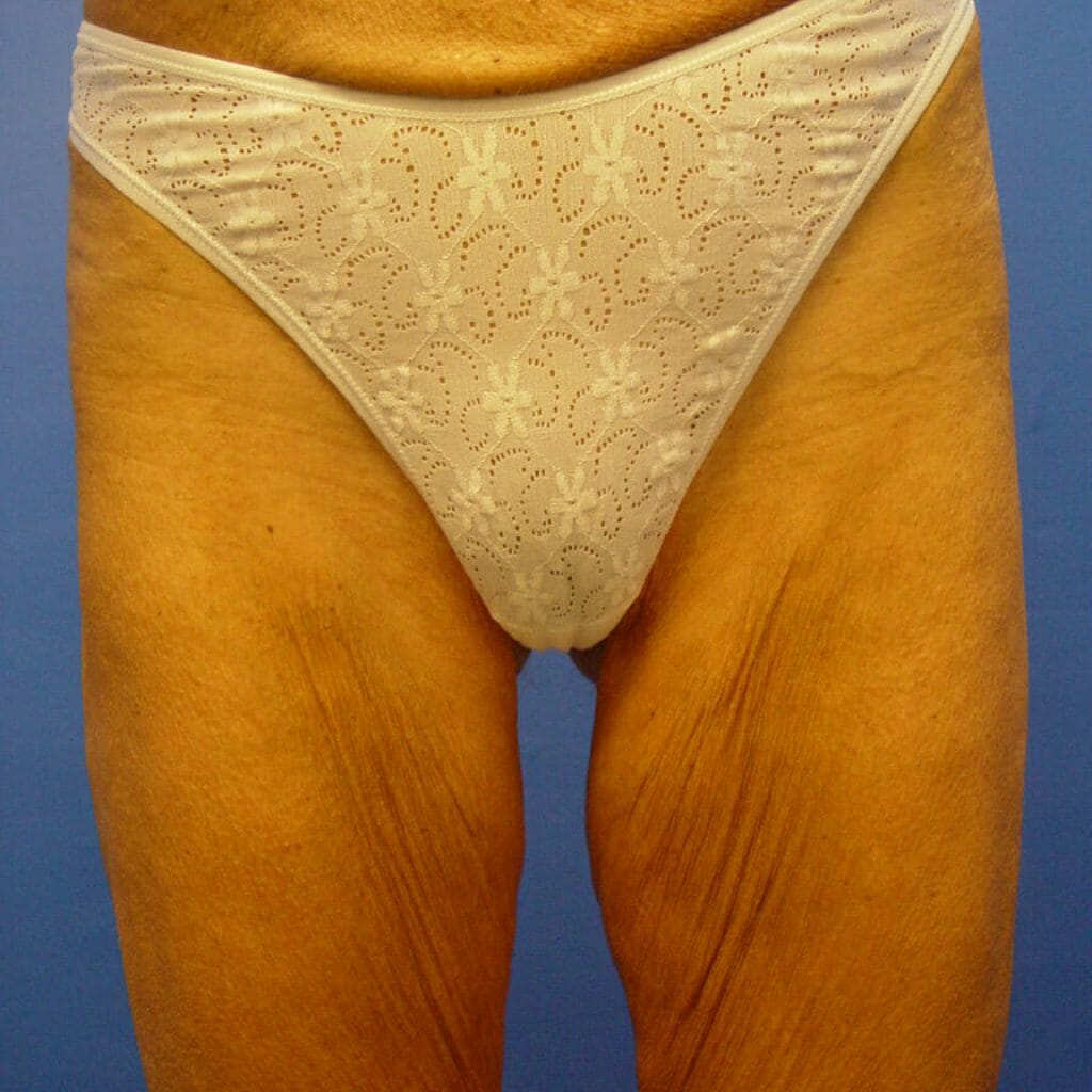 thigh lift aristocrat plastic surgery