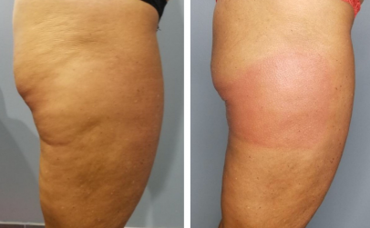 cellulite-before-and-after cellulite-before-and-after