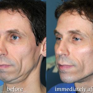 Older male before and after Y Lift procedure