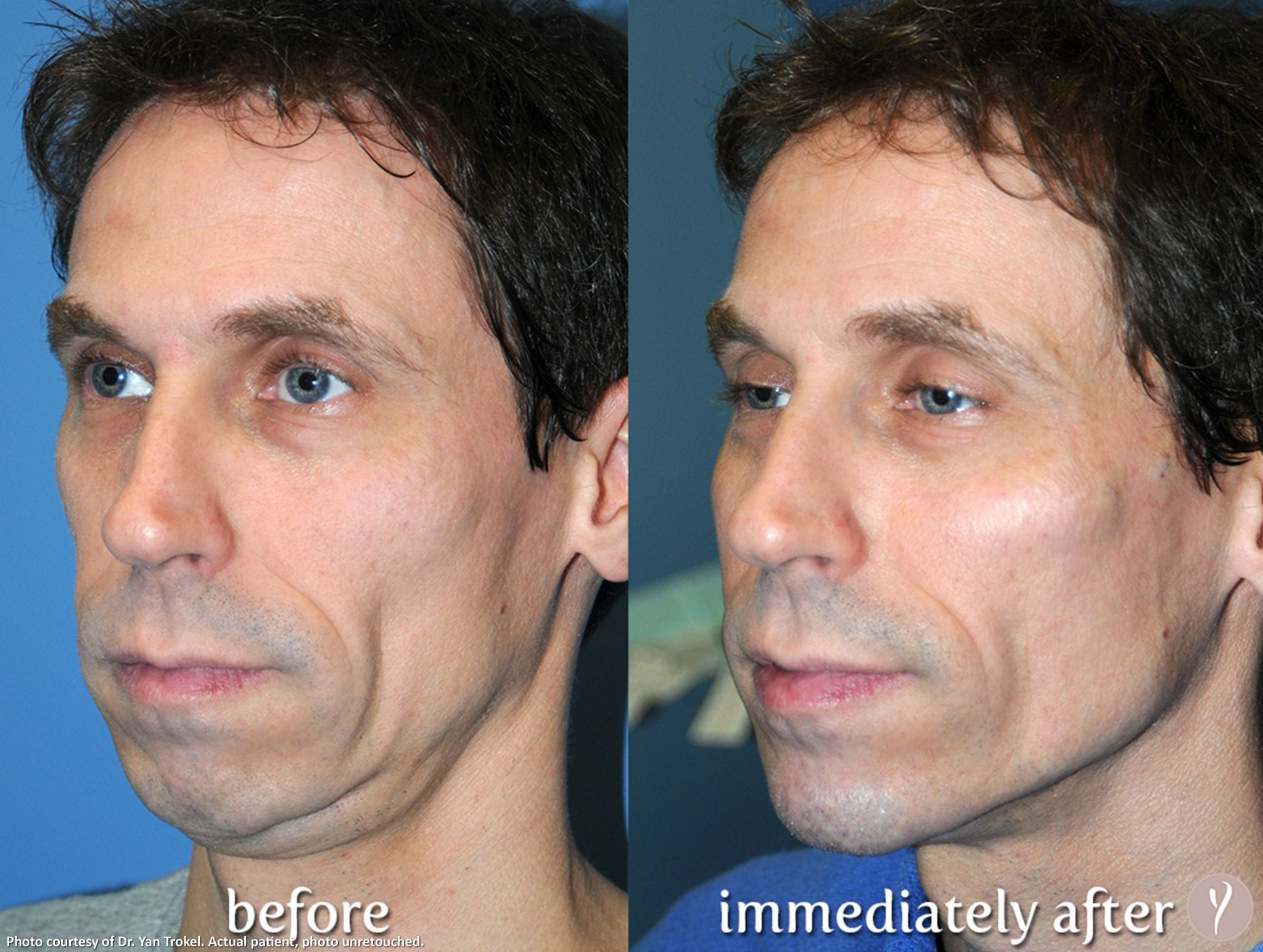 Older male before and after Y Lift procedure
