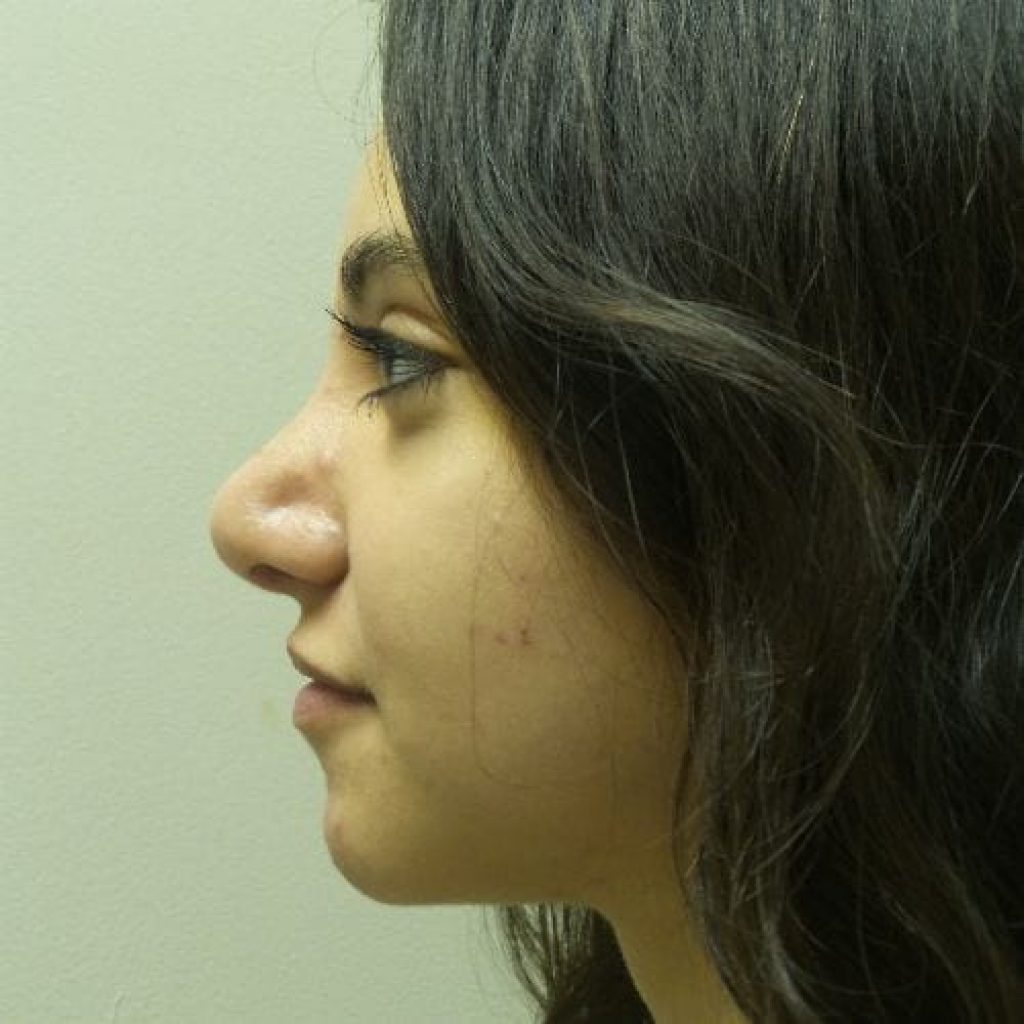 nose surgery patient