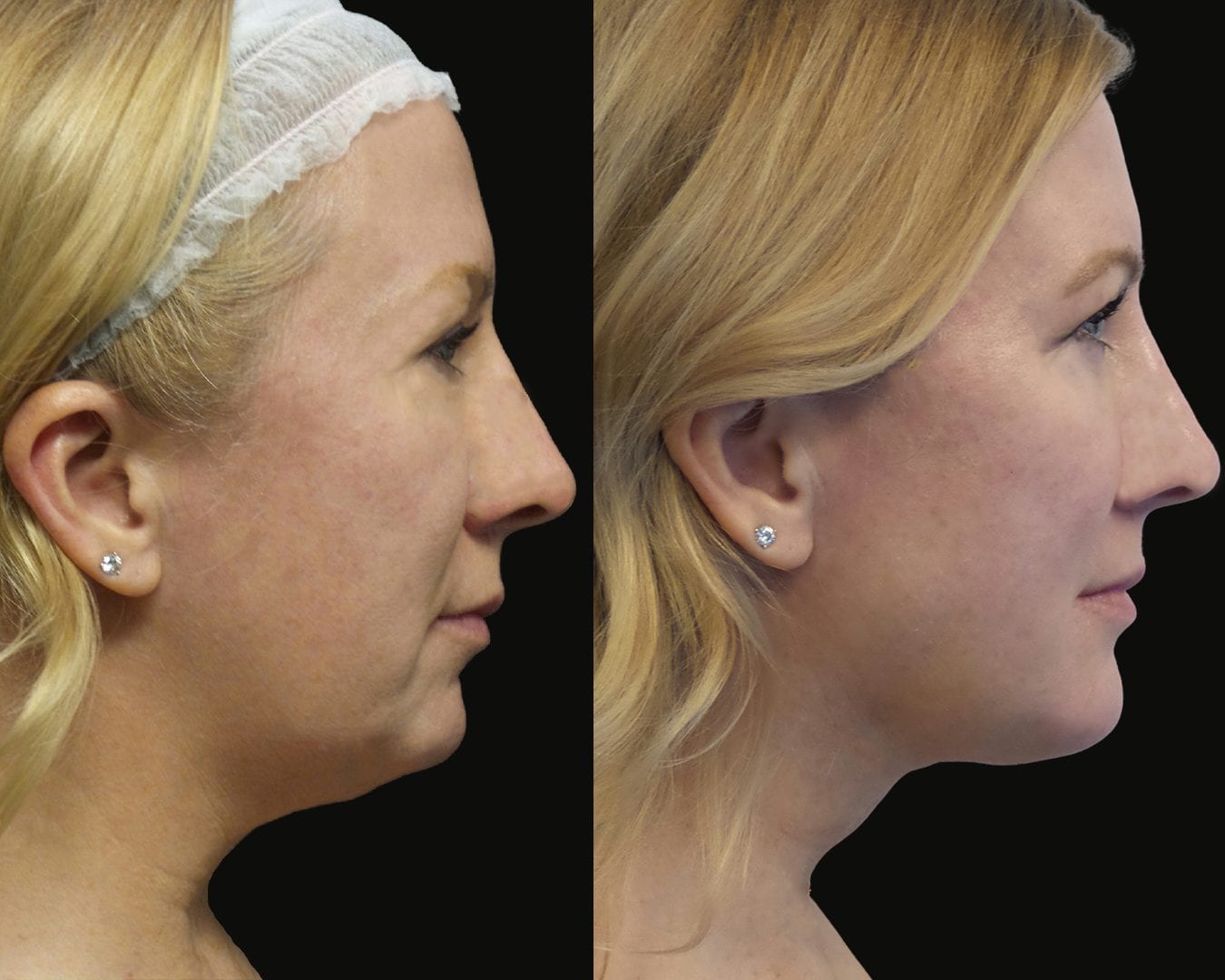 before and after photo of MyEllevate patient