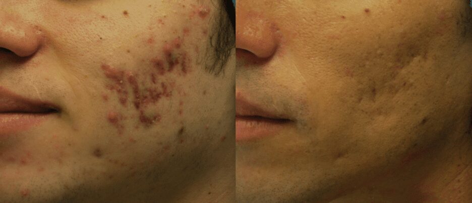 before and after morpheus treatment