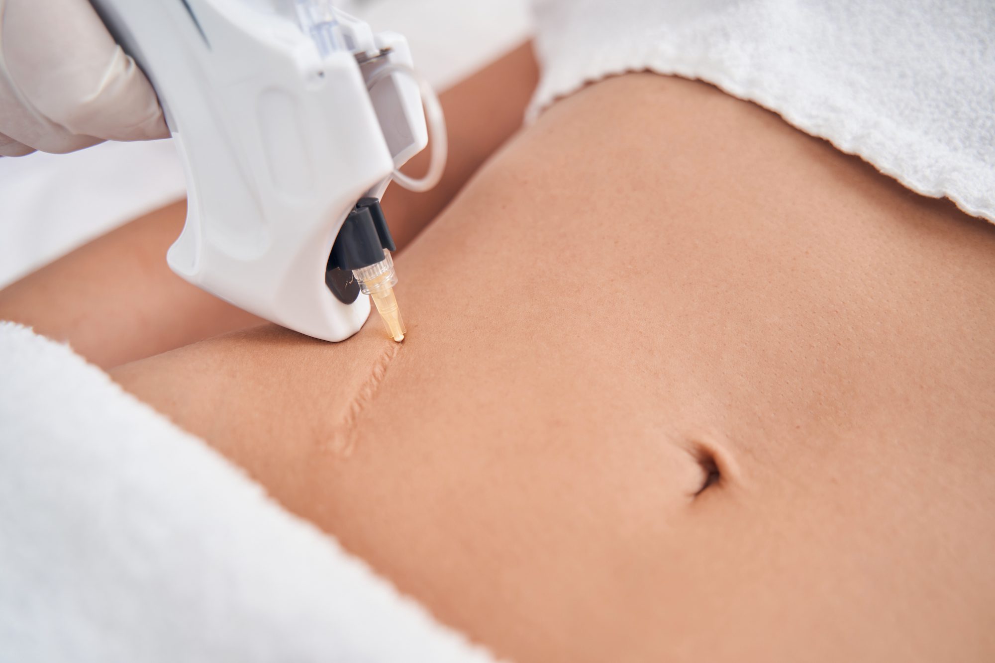 woman receiving scar treatment