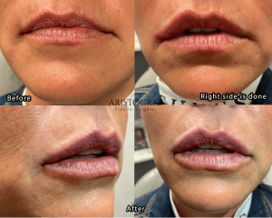 This patient had her lips treated. 