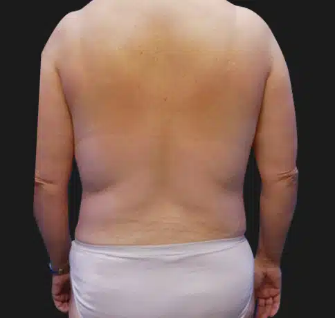 Coolsculpting Before and After​ - Aristocrat Plastic Surgery