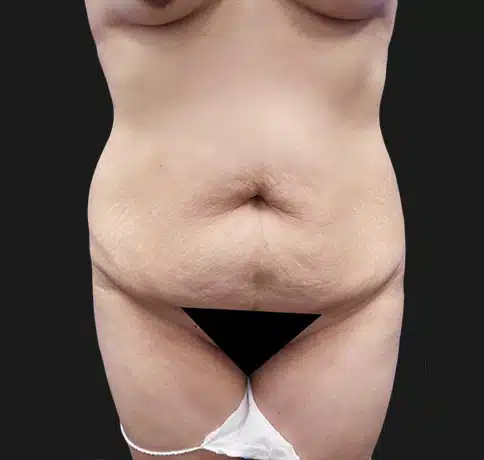 Liposuction Tummy Tuck​ - Aristocrat Plastic Surgery