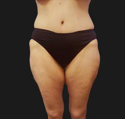 Mommy Makeover After Surgery - Aristocrat Plastic Surgery