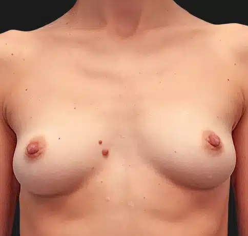 Before After Breast Augmentation NYC - Aristocrat Plastic Surgery​