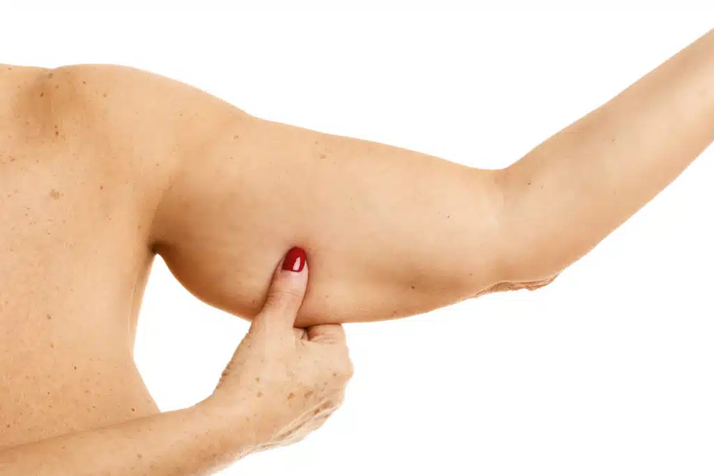 arm liposuction nyc