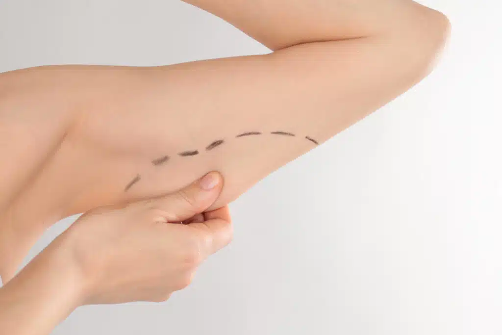 arm liposuction procedure