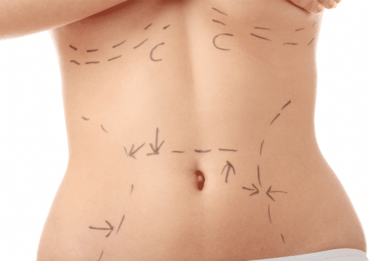 Mommy Makeover in Manhattan and Great Neck, NY - Aristocrat Plastic Surgery