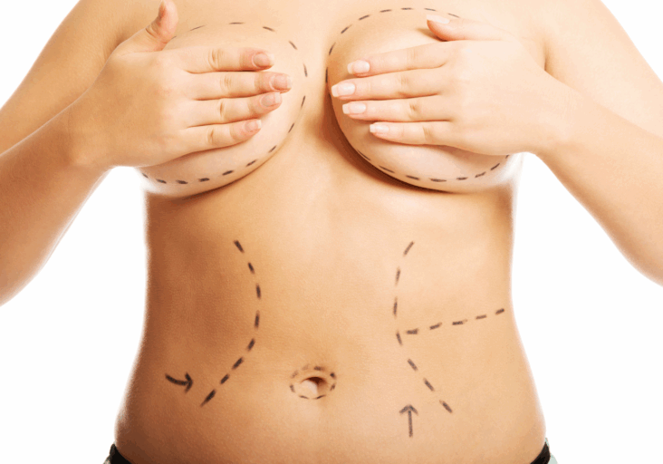 Mommy Makeover in Manhattan and Great Neck, NY - Aristocrat Plastic Surgery