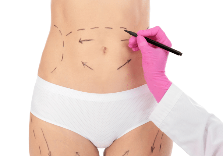 Tummy Tuck Manhattan and Great Neck, NY - Aristocrat Plastic Surgery