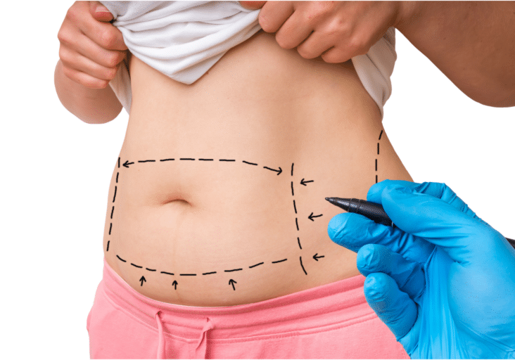 Tummy Tuck Surgery Manhattan and Great Neck, NY - Aristocrat Plastic Surgery