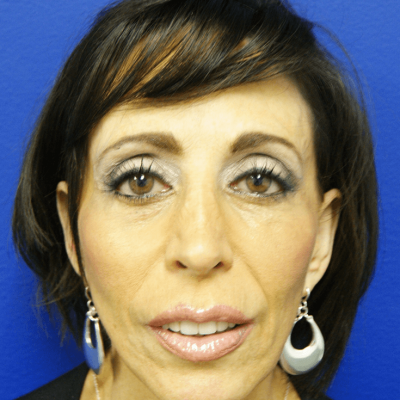 Face Procedures Face Procedures