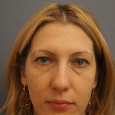 botox-case2-before1-07-30-2015-07-57-37 botox-case2-before1-07-30-2015-07-57-37