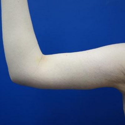 brachioplasty-case4-after1-07-30-2015-08-03-46 brachioplasty-case4-after1-07-30-2015-08-03-46