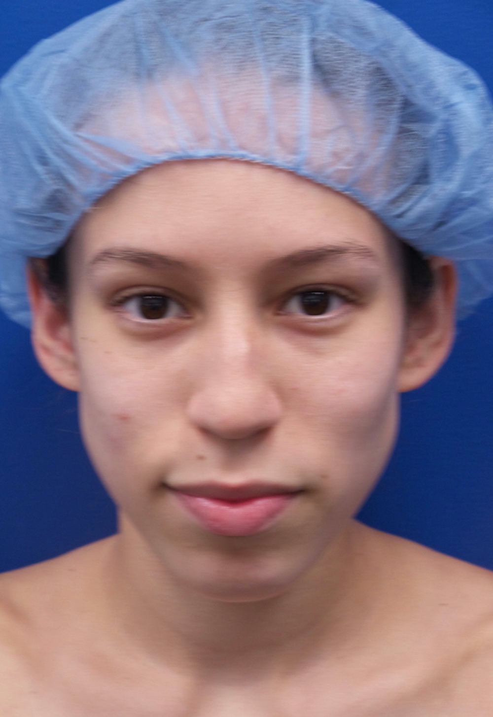 Nose Surgery 38420 Aristocrat Plastic Surgery