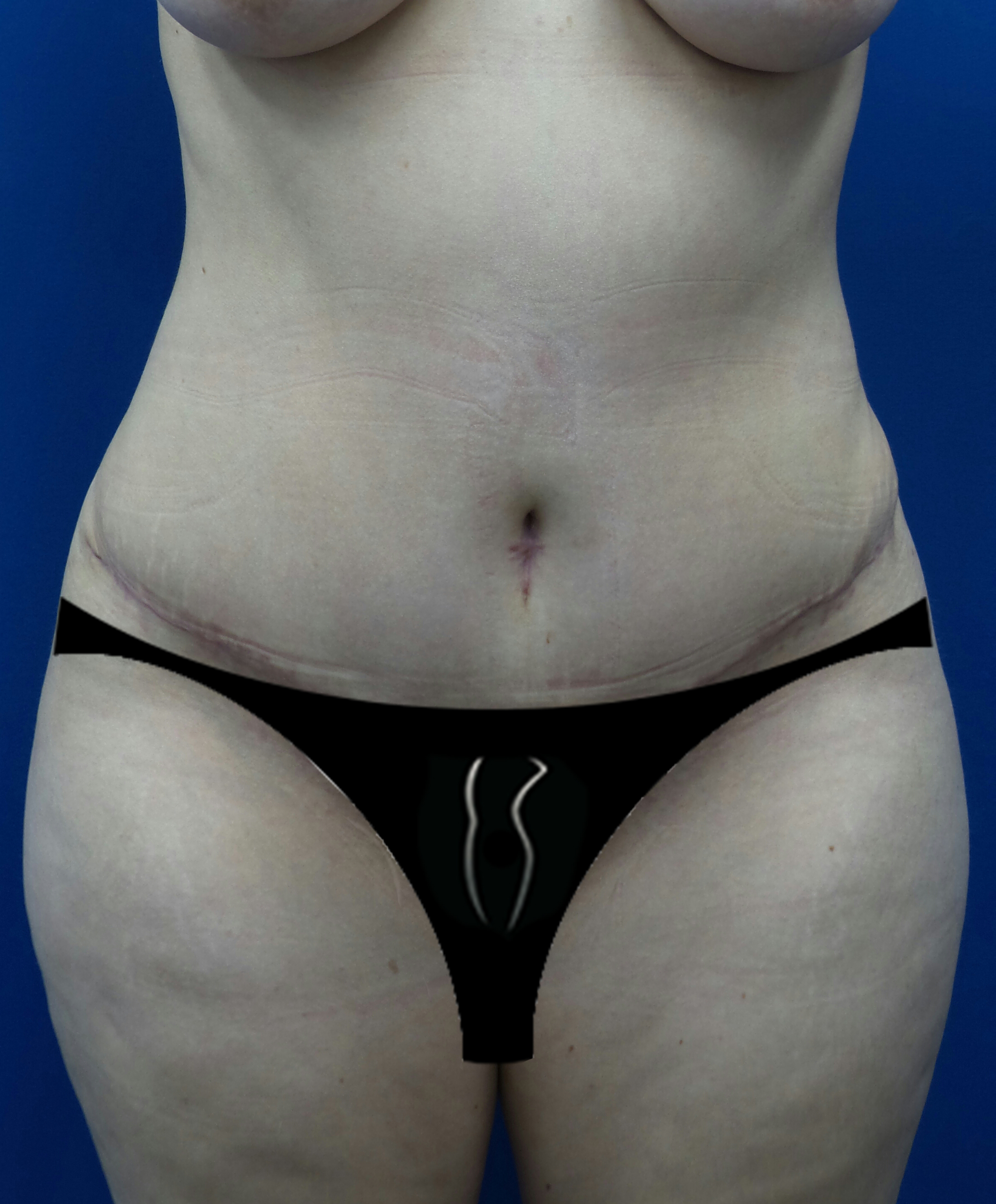 Tummy Tuck Revision – Aristocrat Plastic Surgery