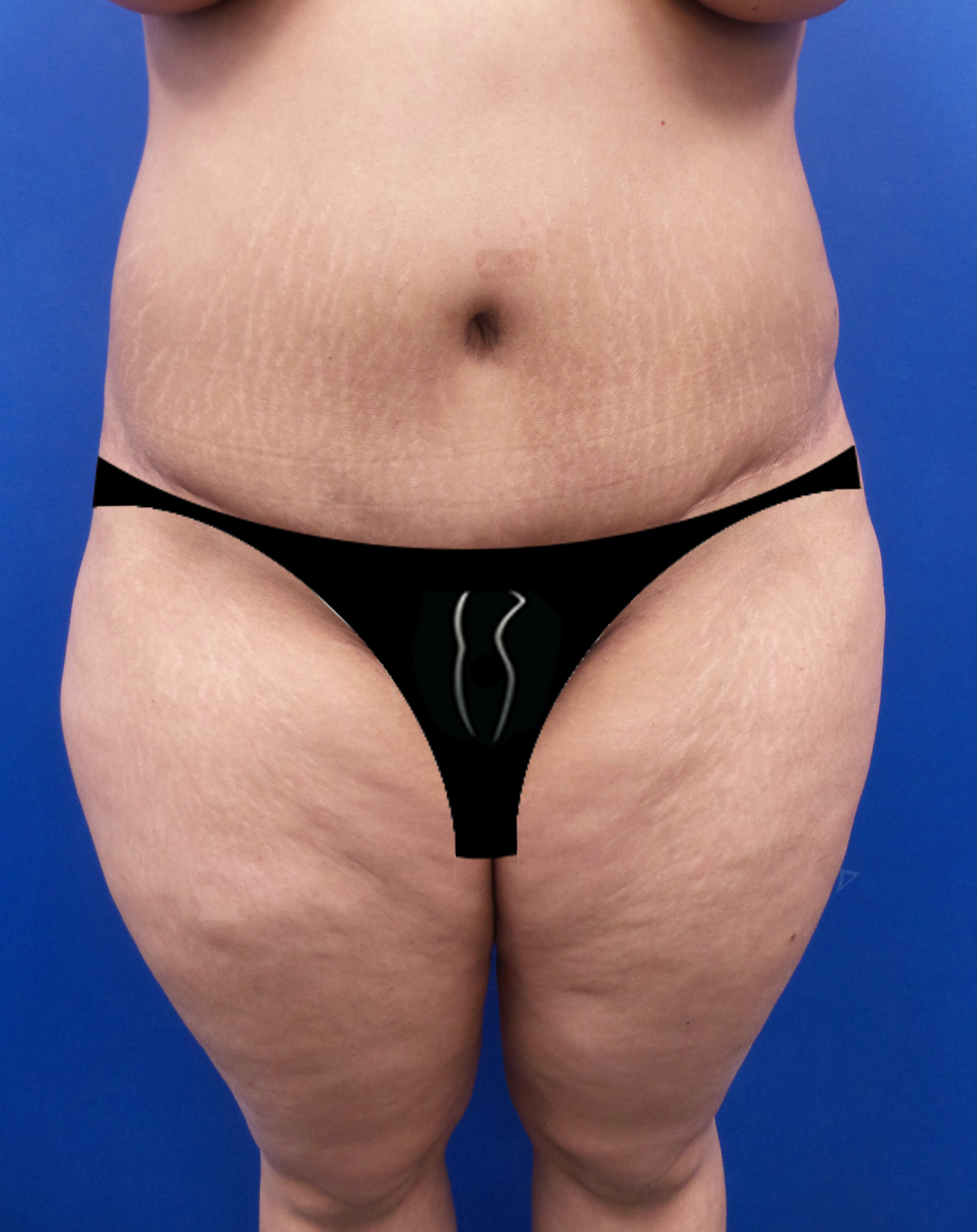 Revision liposuction – harder than you think!, Plastic Surgeon San  Francisco