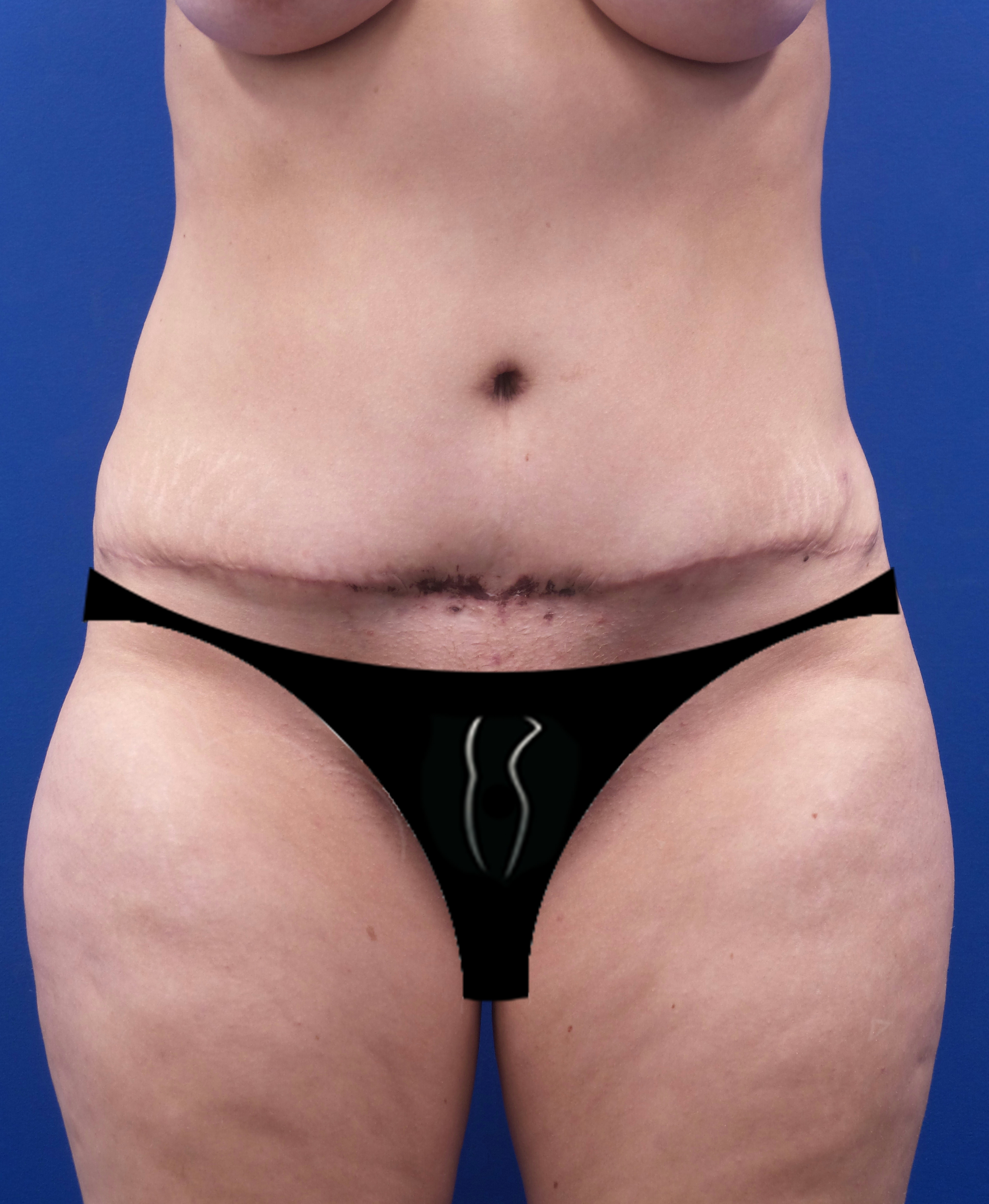 Tummy Tuck - 44000 – Aristocrat Plastic Surgery