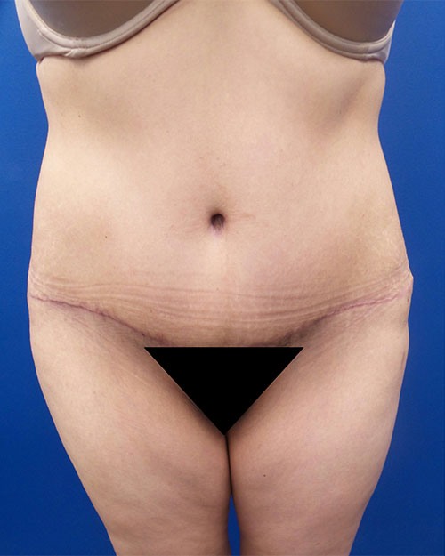 Tummy Tuck Revision – Aristocrat Plastic Surgery